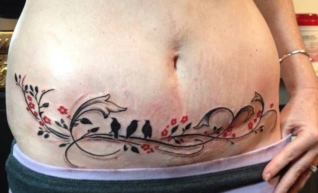 Tatuajes tapar cicatrices abdominoplastia 2