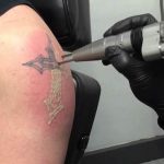 Borrar tatuajes con láser