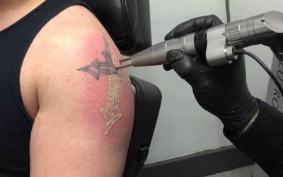 Borrar tatuajes con láser: Te resolvemos las principales dudas