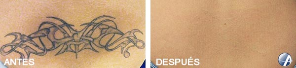 Antes y después eliminación tatuaje tribal