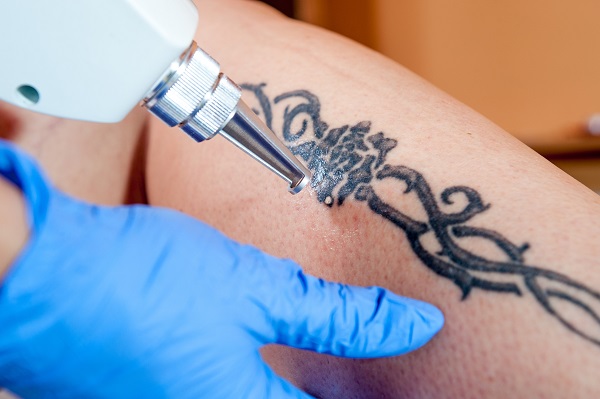 Eliminación tatuaje láser
