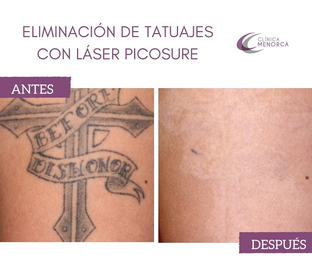 Encontrar centros de tatuajes y de eliminación de tatuajes en Madrid • Tatuajes pequeños